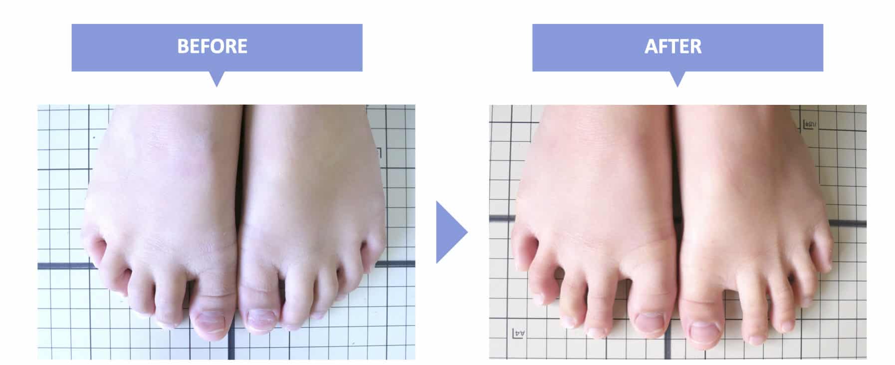 足の指が曲がって痛い！ハンマートゥの治し方と自宅ケア・手術の基準
