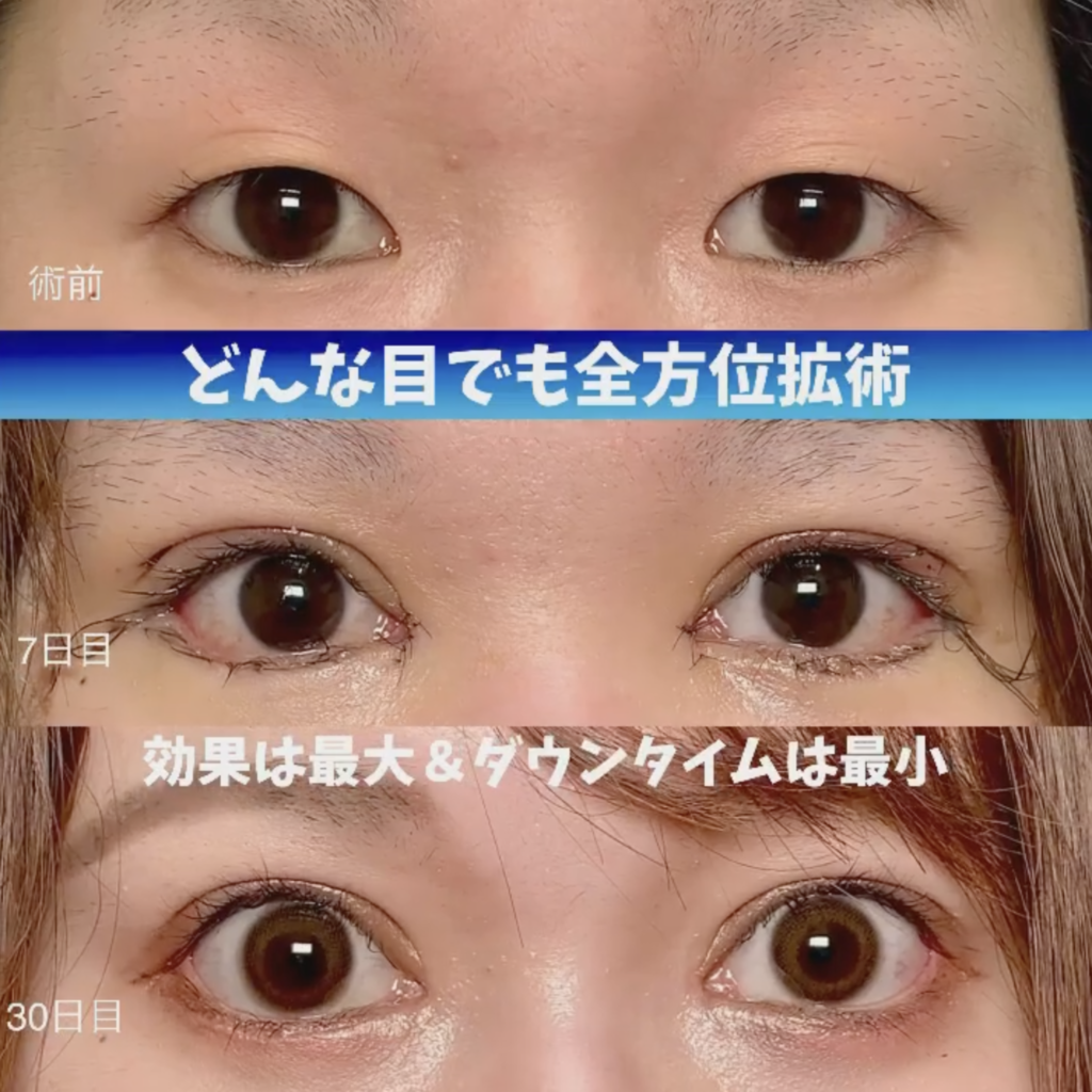 目頭切開のダウンタイムは何日？腫れピークと傷跡隠し方を徹底解説