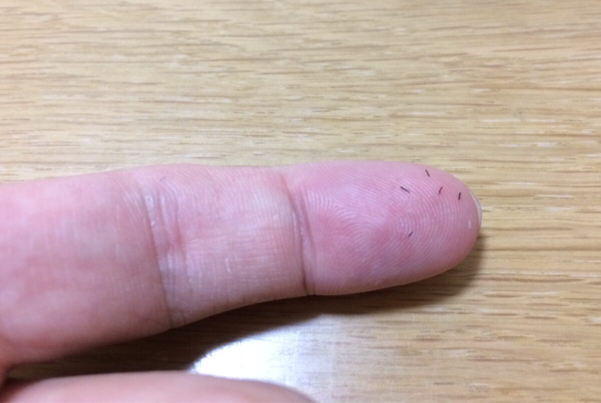 医療脱毛はいつ抜ける？1〜2週間でポロポロ抜けない決定的な理由と真相