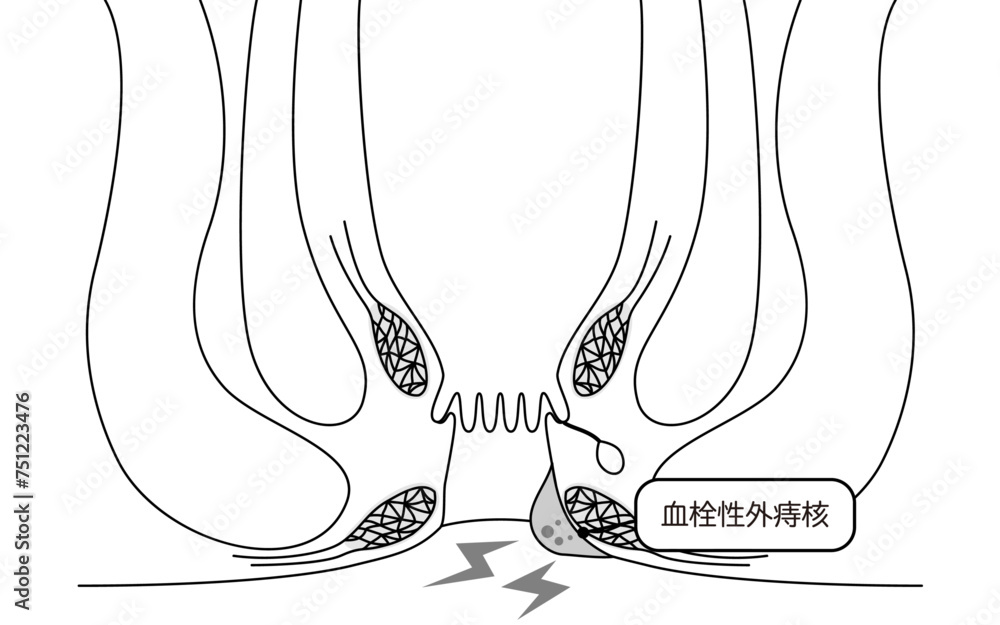 血栓性外痔核が治らない原因とは？しこりが消える期間と受診の目安