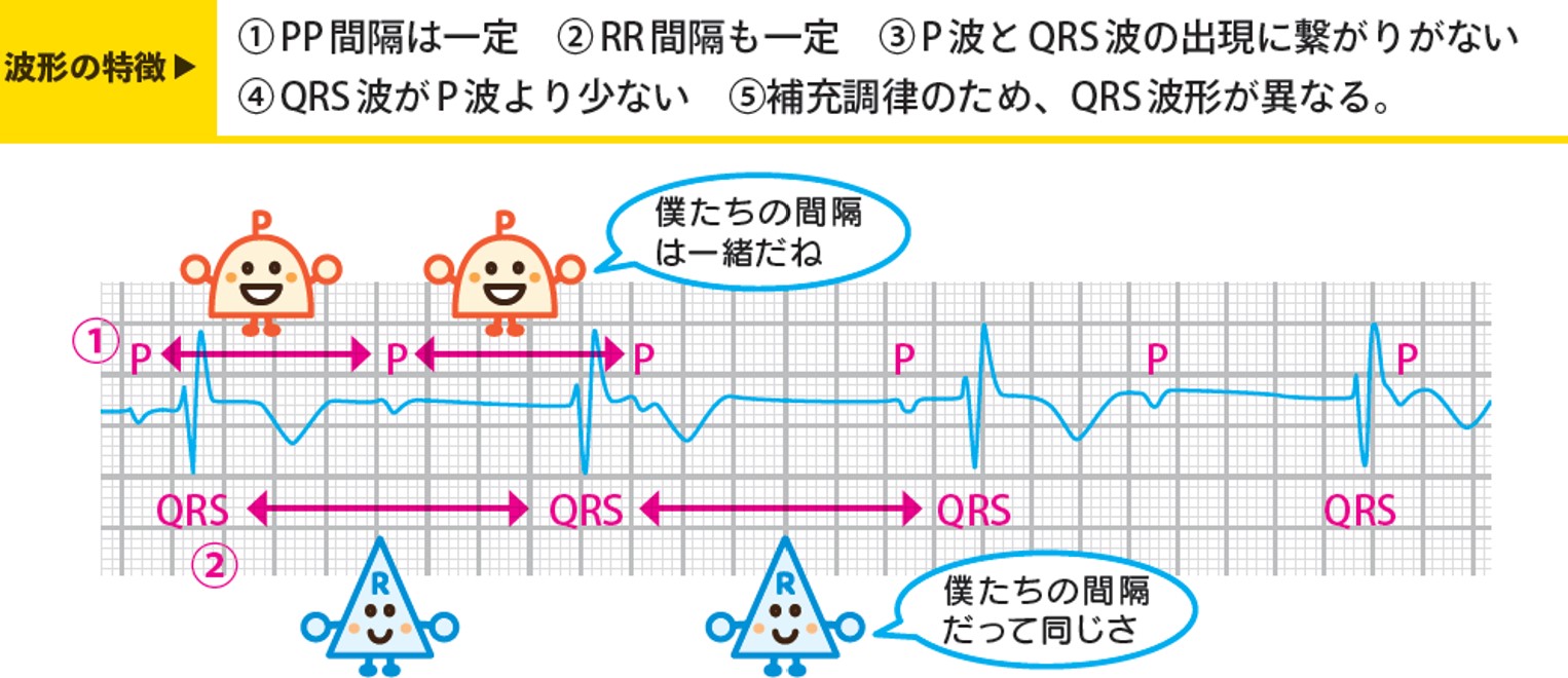 完全房室ブロックの真実｜失神や突然死リスクと最新治療法