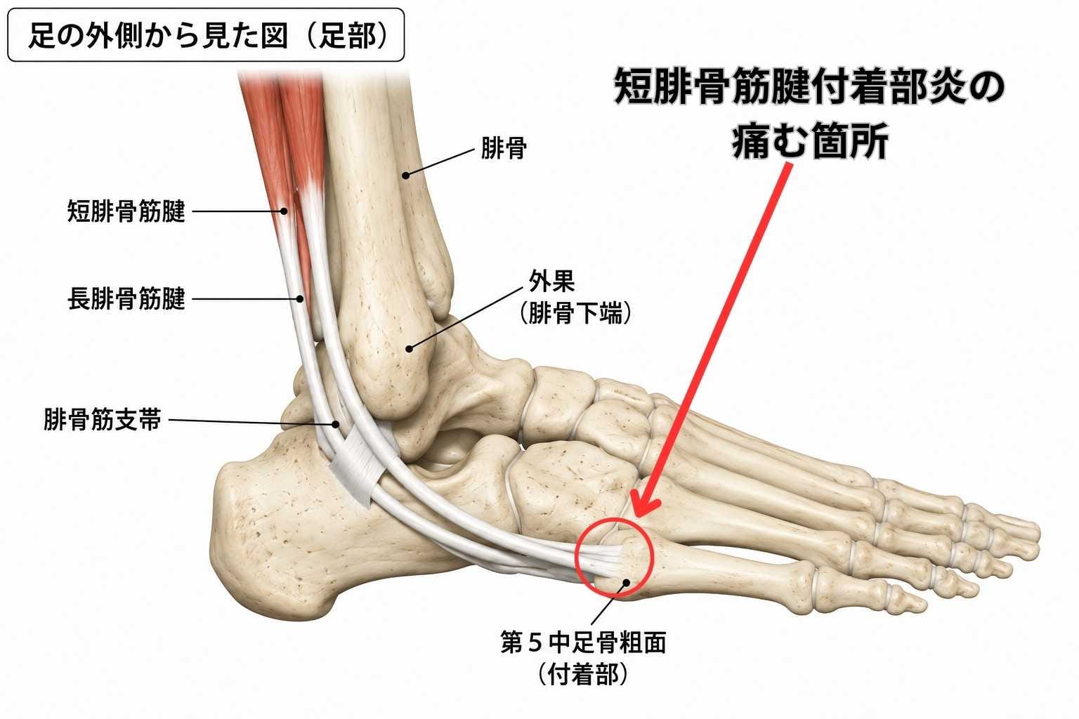 短腓骨筋腱付着部炎の原因と治し方｜骨折との見分け方や早期改善法