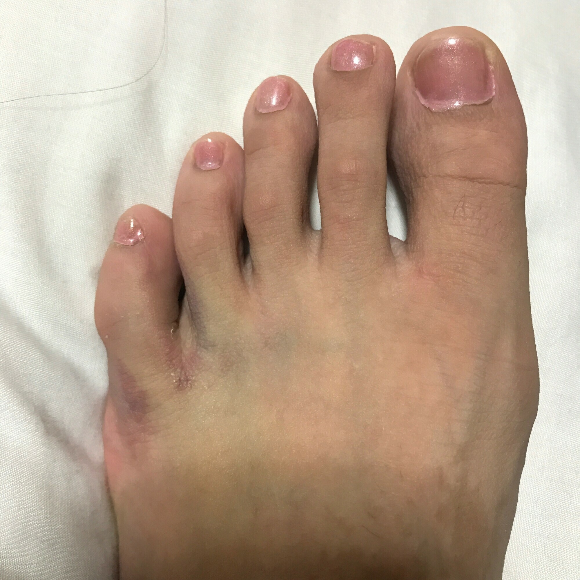 足の小指をぶつけた激痛！打撲と骨折の見分け方＆応急処置ガイド