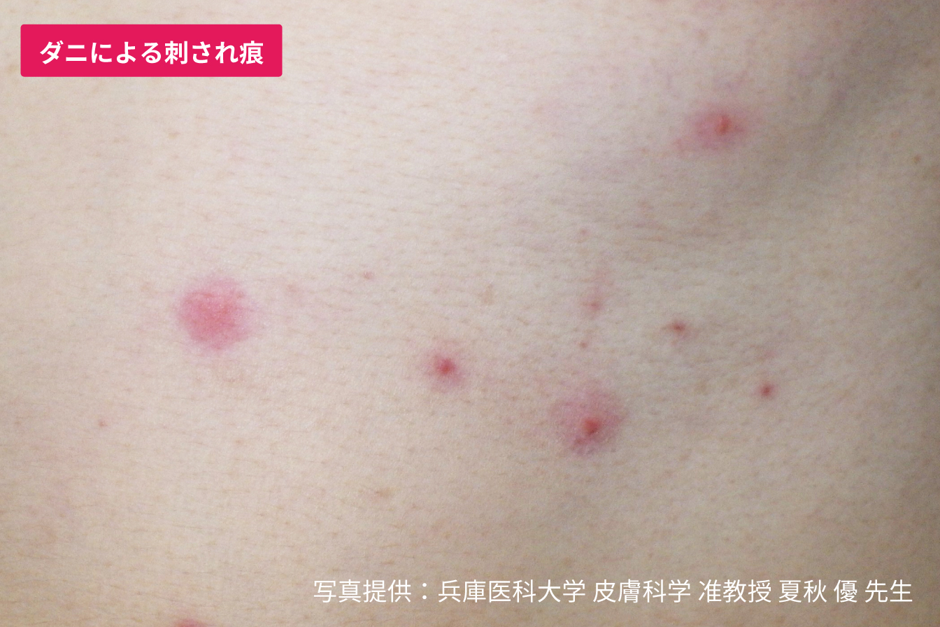 ダニ刺されの跡と特徴は？蚊との見分け方やしこりの正体を徹底解説