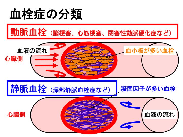 【独自取材】デスクワークの日常に潜む「見えない時限爆弾」——2026年、現役世代を脅かす血栓症の真実と生還への分かれ道