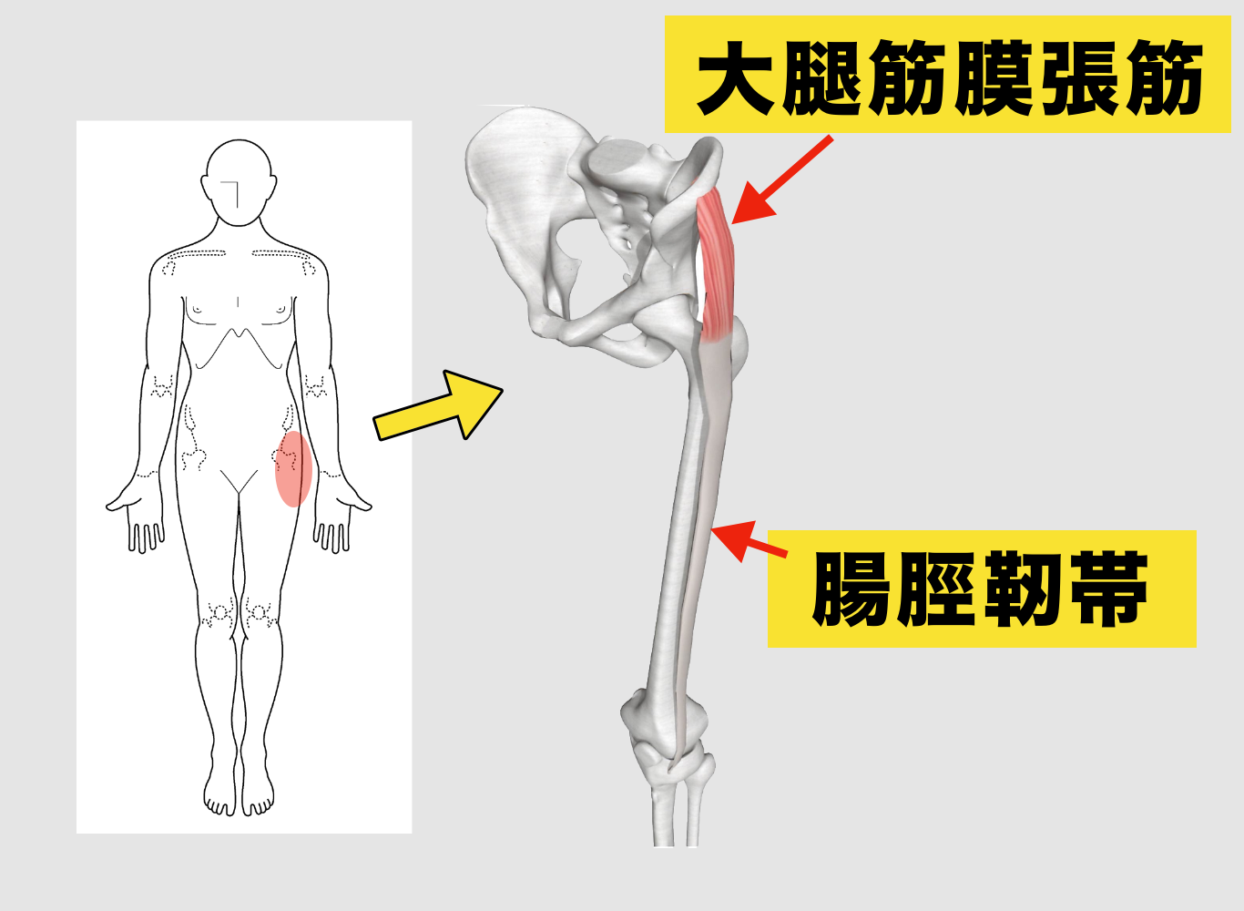 太もも外側の張り・股関節痛を根本解消！大腿筋膜張筋のほぐし方大全