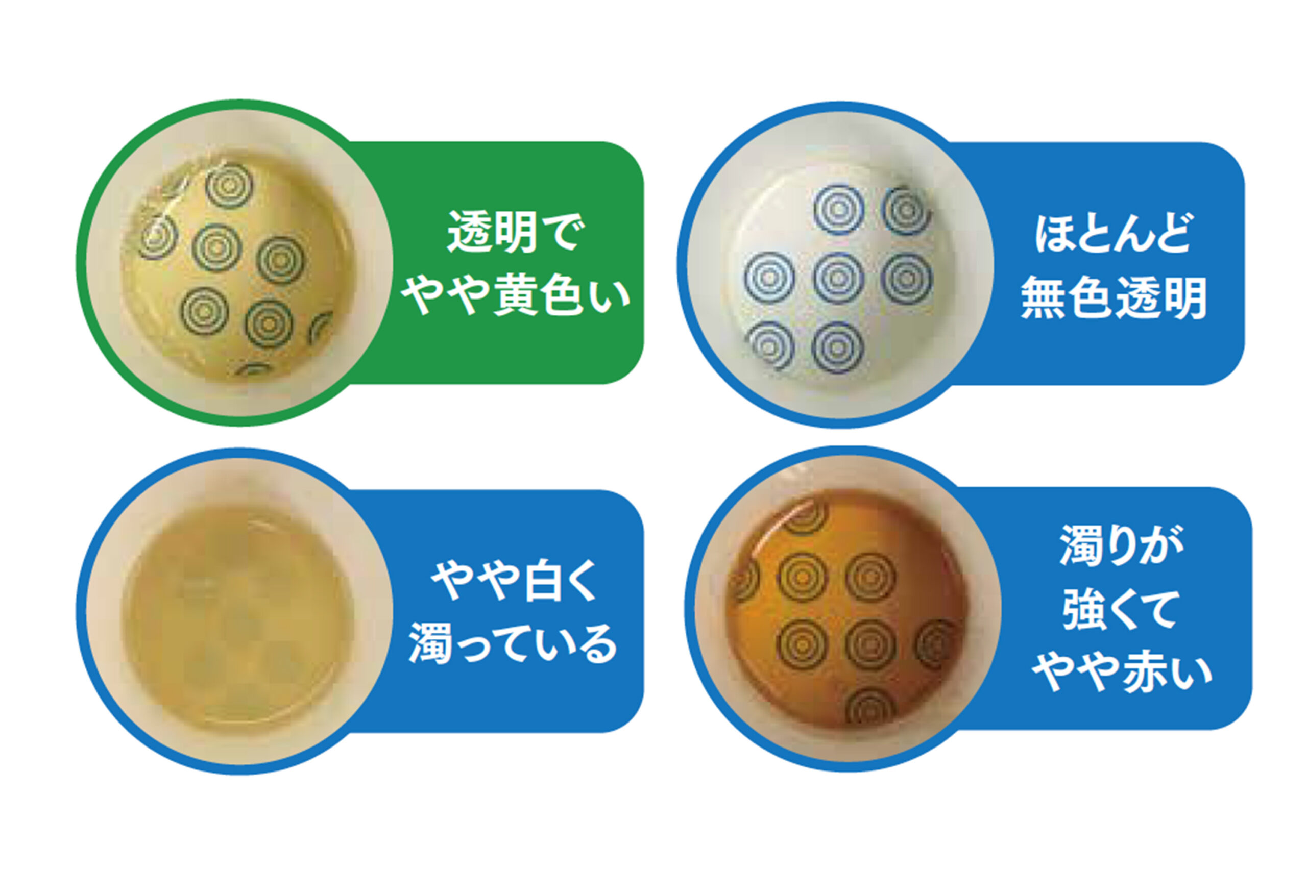【写真で比較】尿が泡立つのは腎臓病のサイン？消えない危険な泡と受診目安