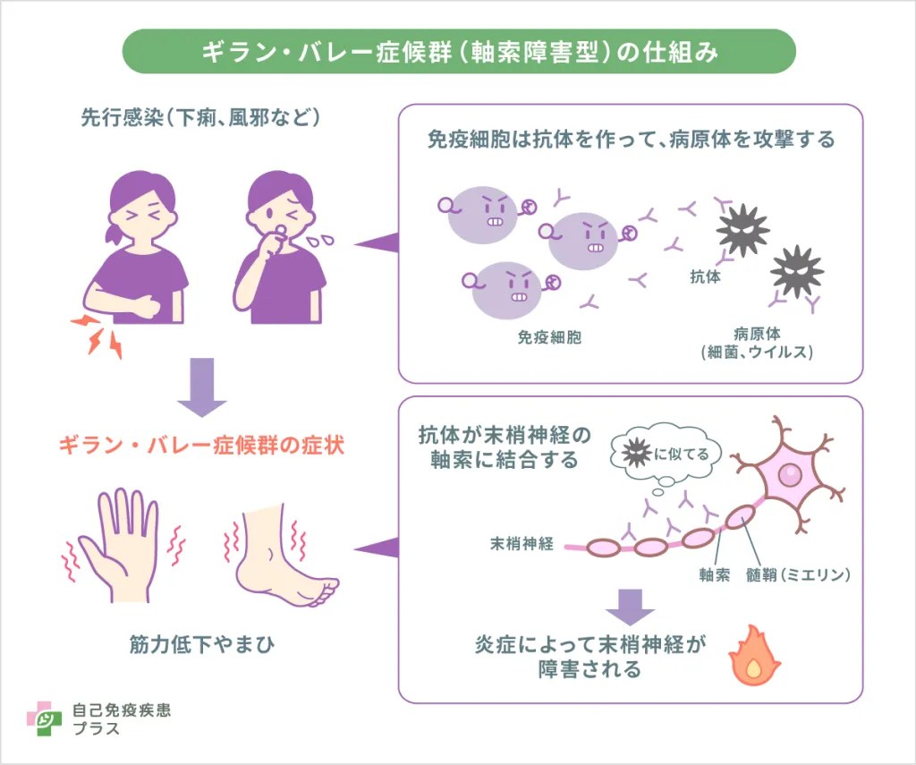 ギラン・バレー症候群の原因とは？風邪や鶏肉食中毒から麻痺する真相