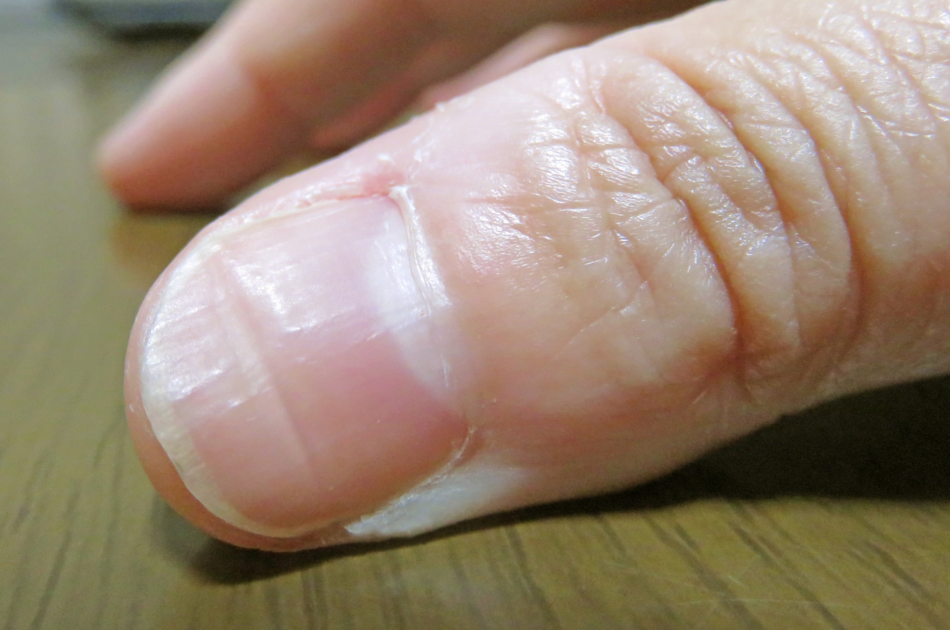 爪に線が入る原因と病気危険度｜黒い筋や凹凸の真相と見分け方を解説