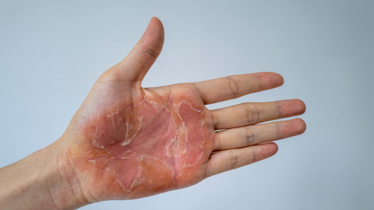 手のひらの皮がむける原因は？病気サインの見分け方と最新治し方