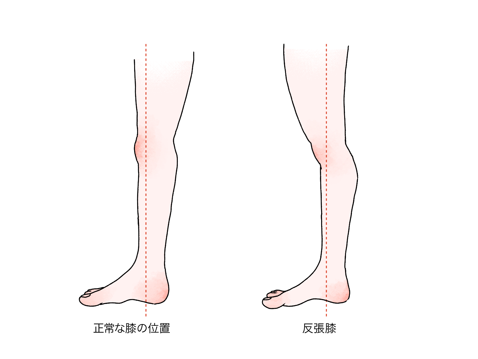脚の太さや腰痛の元凶「反張膝」を暴く！原因と根本改善ストレッチ