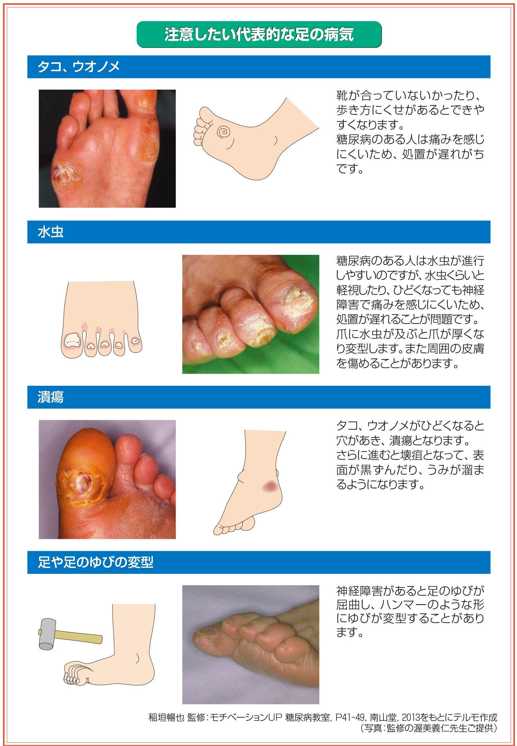 糖尿病の足の症状と変色サイン｜切断を防ぐ危険度チェックと対策