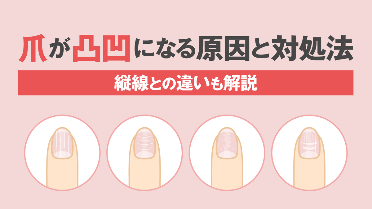 爪の表面が凸凹なのは病気のサイン？縦線・横線の原因と改善ケア徹底検証