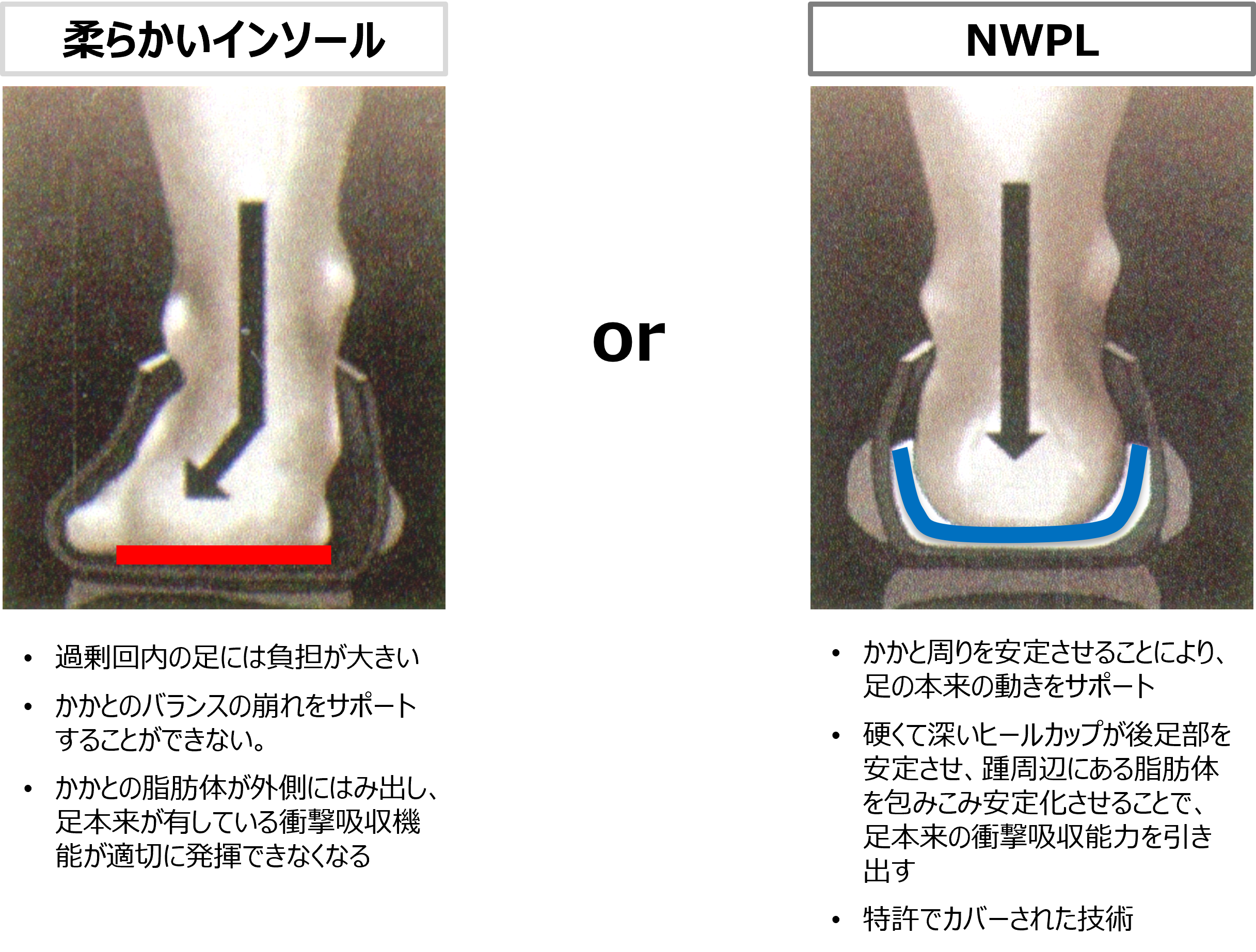 オーバープロネーション改善法と見分け方｜原因と靴選びを徹底解説