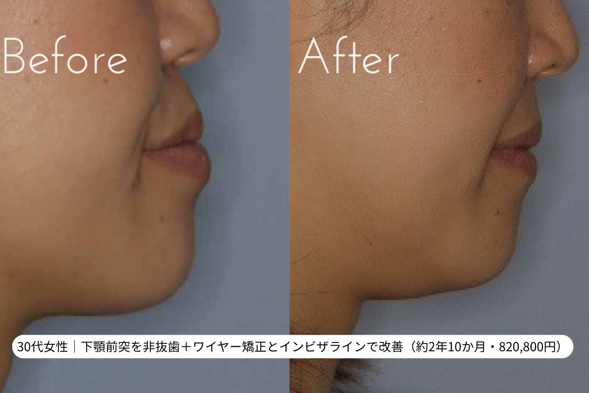 顎が出てる悩みを完全解消｜原因の見分け方と自力ケア・最新治療費