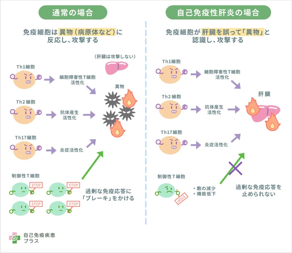 自己免疫性肝炎は寿命に影響する？余命の真相と生存率の最新データ
