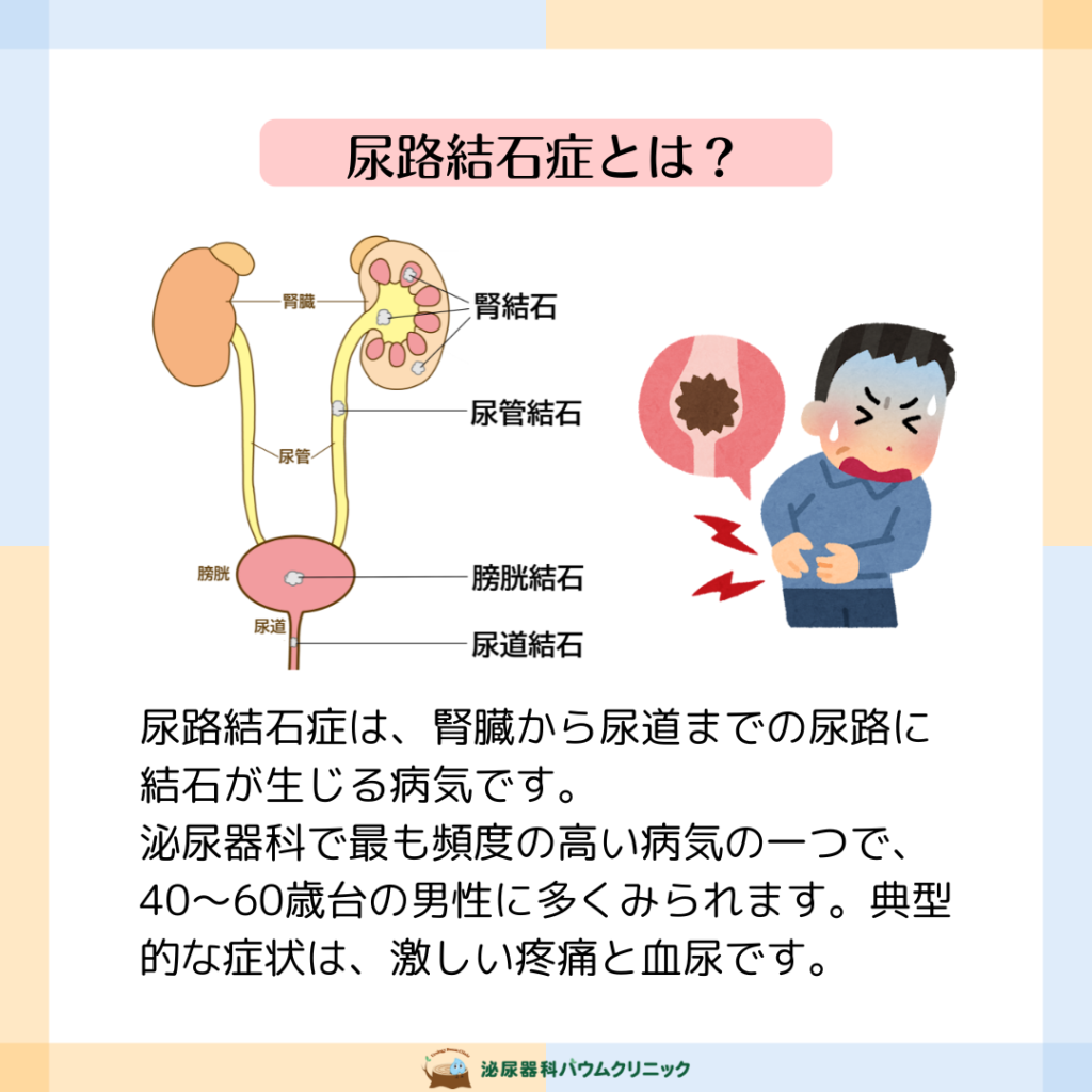 尿路結石の激痛なぜ？痛む場所や前兆と救急車を呼ぶ基準【2026】