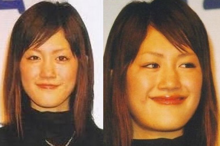 顎変形症を公表した芸能人の現在｜劇的変化と過酷な手術の全真相