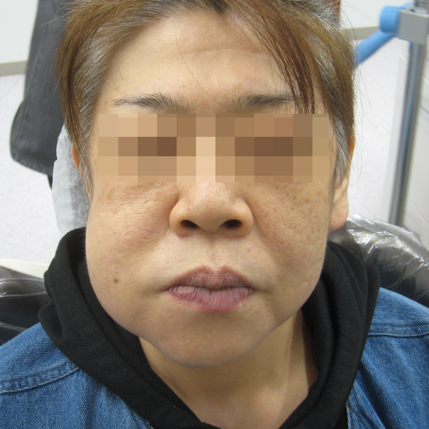 虫歯で顔が腫れる原因と危険性｜蜂窩織炎のリスクと緊急対処法