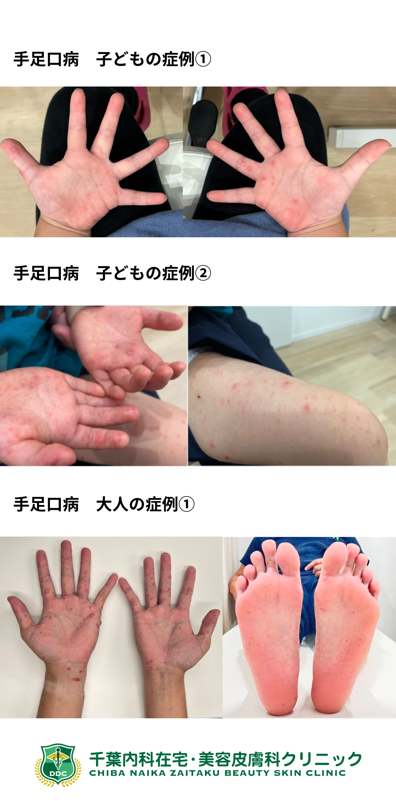 手足口病の感染期間はいつまで？便から数週間の真相と大人の重症化