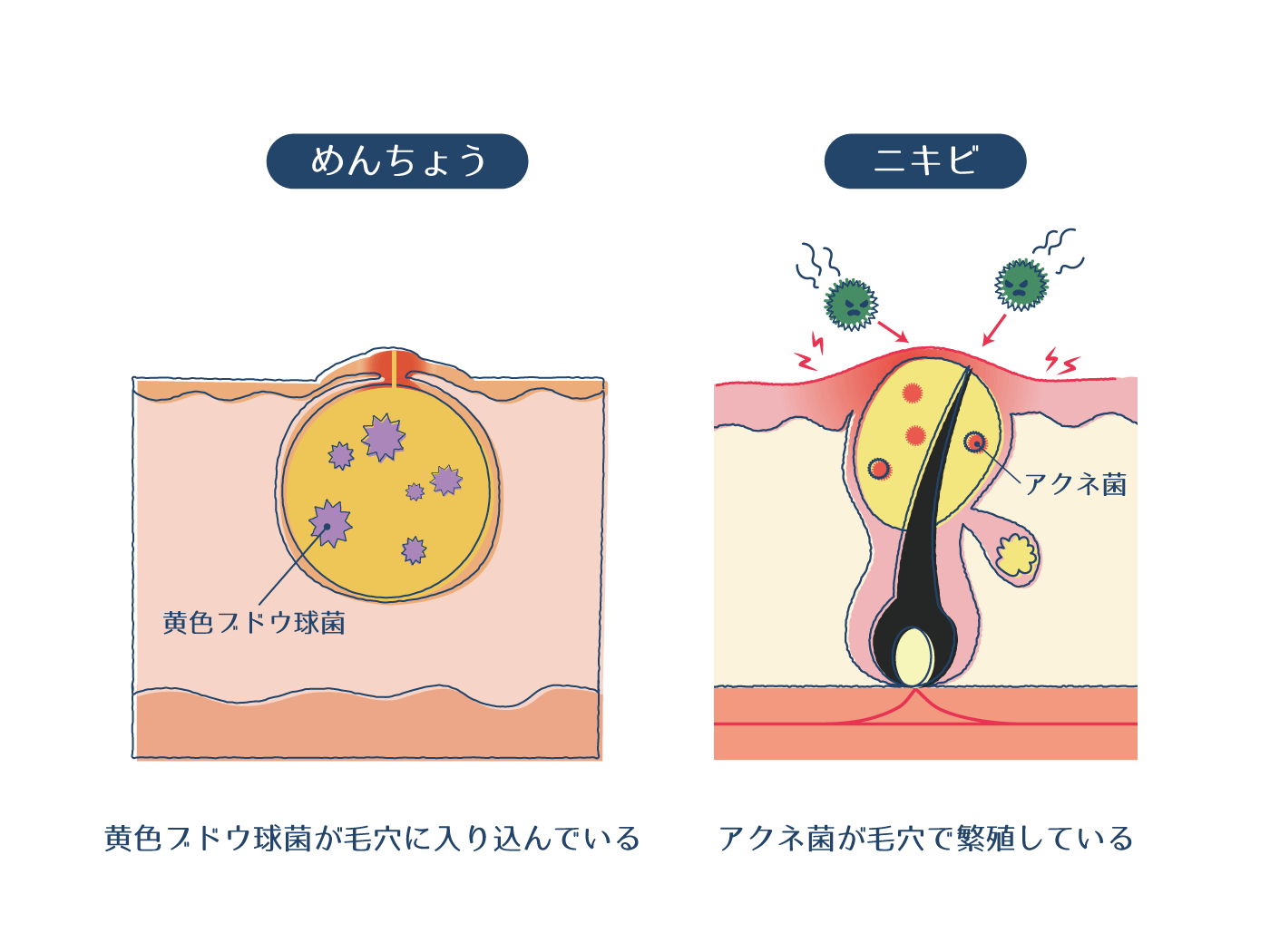 鼻や口周りの激痛「面疔とは」ニキビとの違いと放置厳禁の理由【2026】