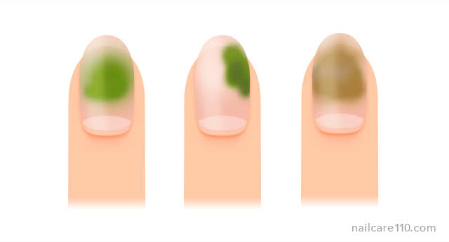 グリーンネイルの治し方完全ガイド｜削るのはNg？皮膚科受診と自然治癒の真実