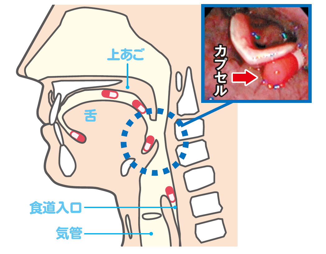 錠剤が喉に引っかかる原因と対処法｜食道潰瘍の危険と違和感の正体