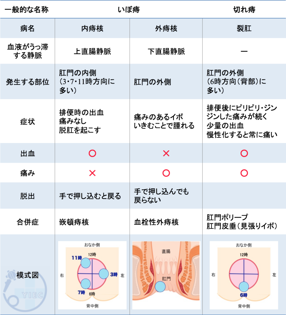 痛くないぷにぷにいぼ痔の正体は？原因と放置リスク・治し方解説