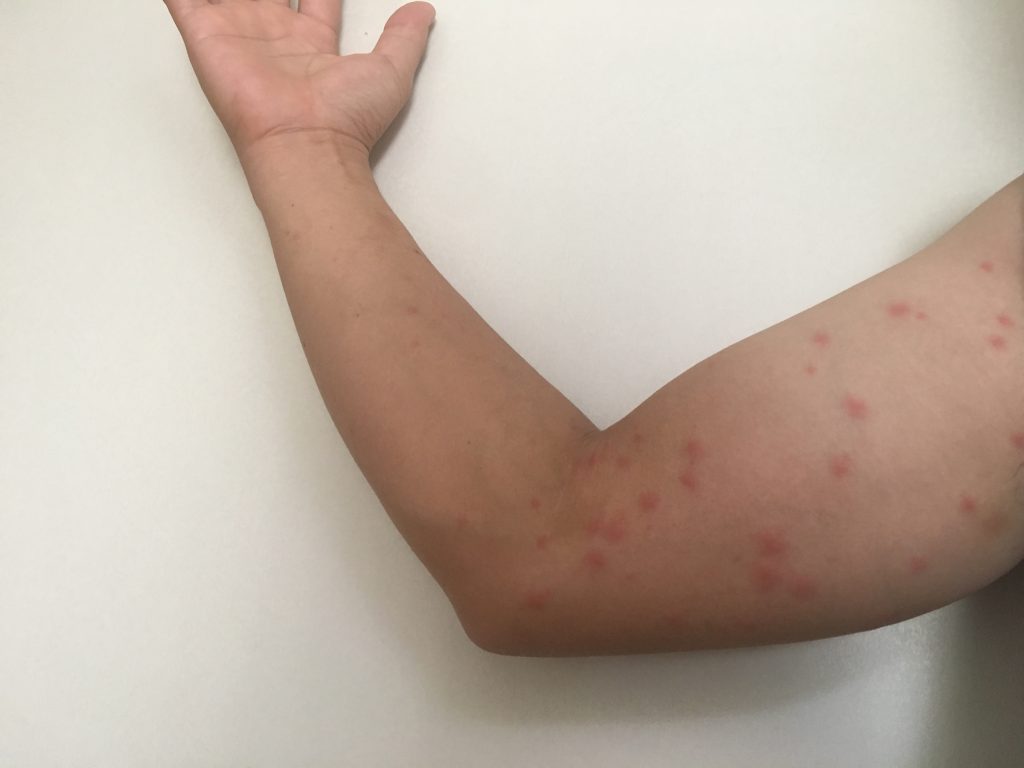 毛虫に刺された時の正しい応急処置！激痛とかゆみを防ぐ対処法