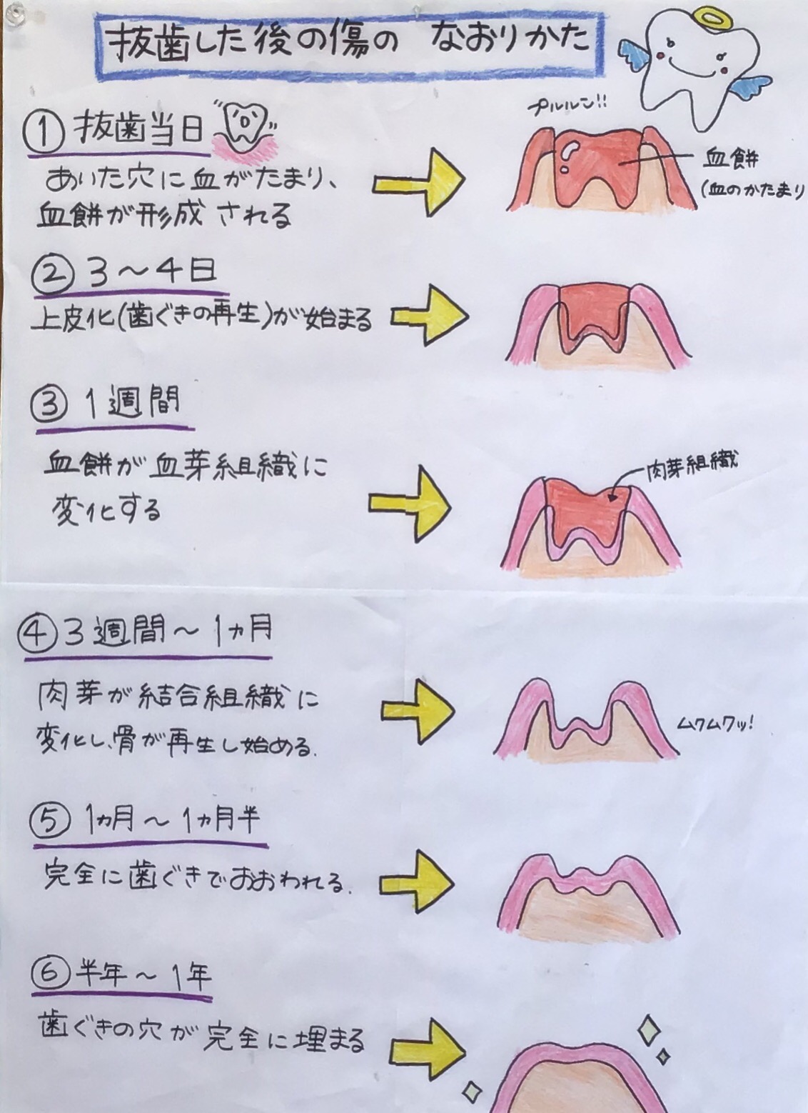 親知らず抜歯後の運動はいつから？筋トレやランニング再開の安全基準