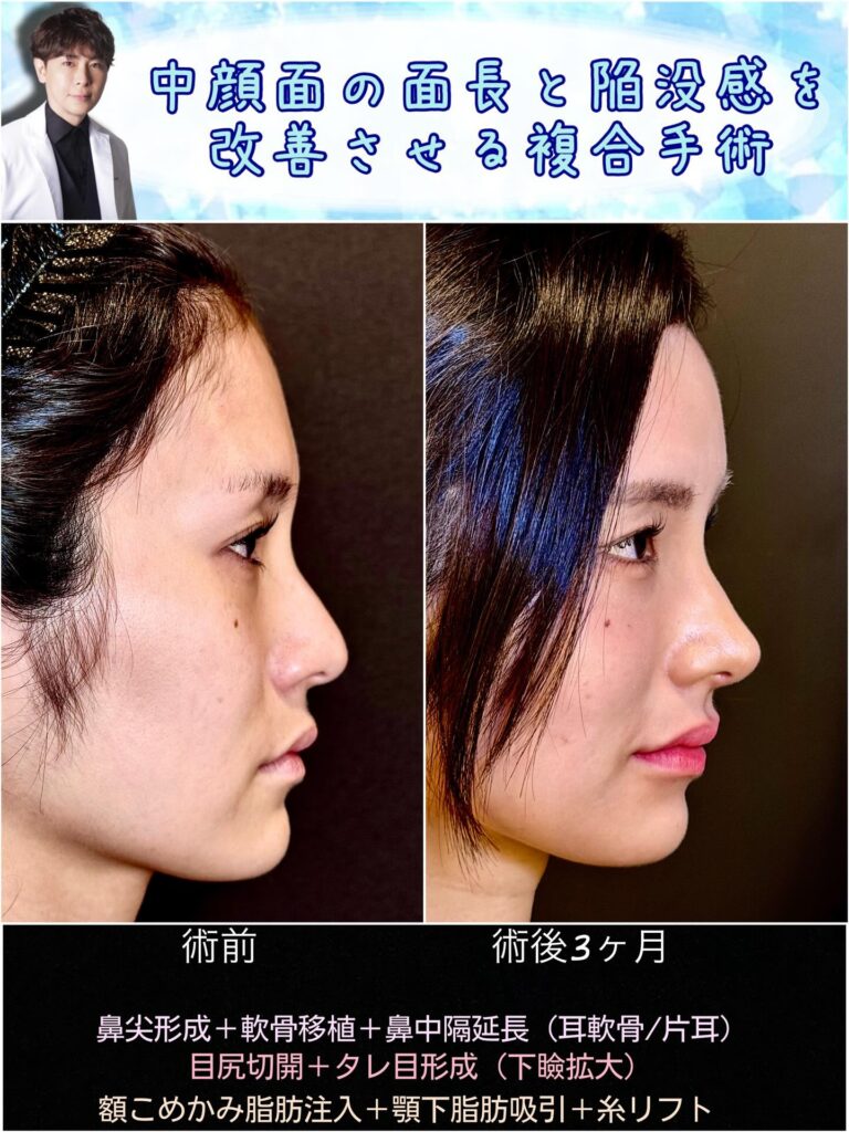 中顔面陥没の原因と治し方を徹底解剖！貴族手術や骨切り術の真実