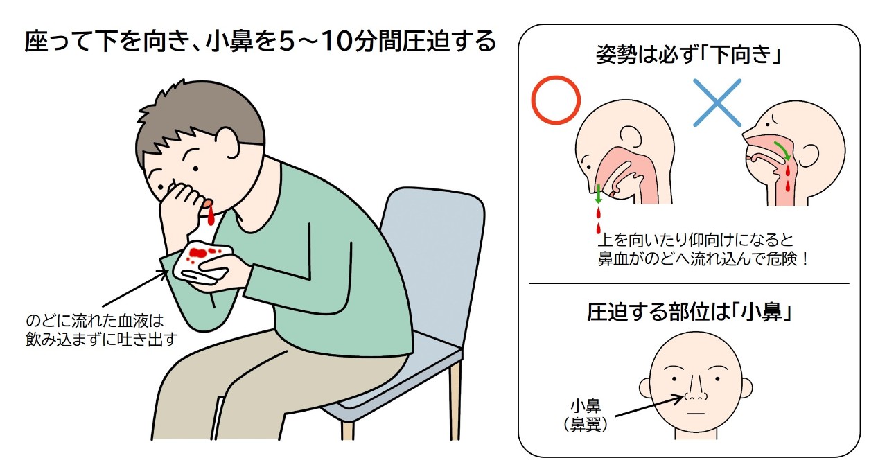 鼻血が止まらない時の正しい対処法｜危険な病気のサインと受診の目安