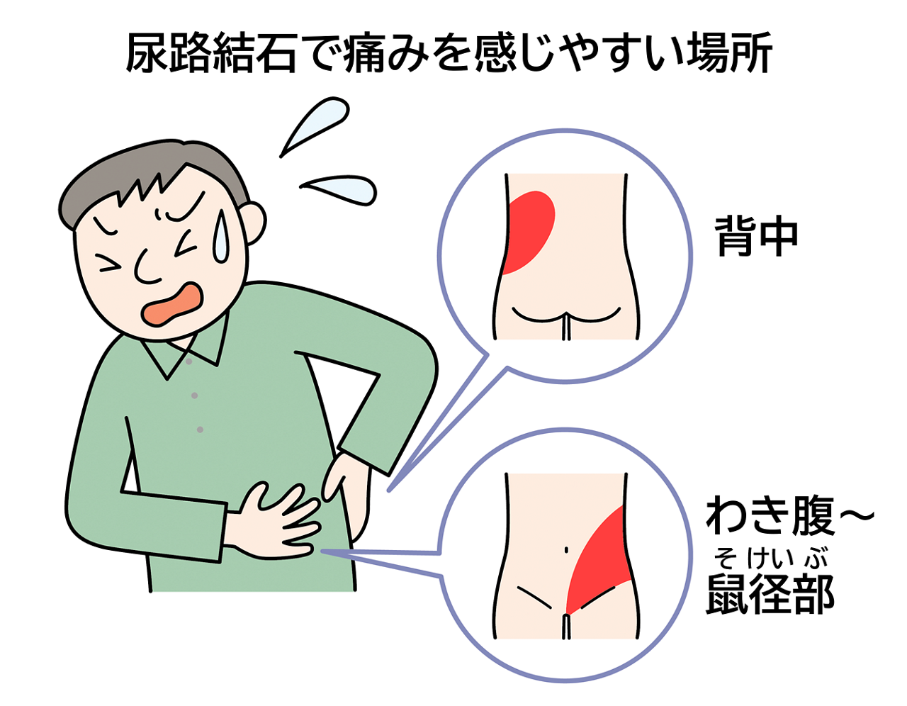 尿管結石の激痛はなぜ起きる？痛みの場所や前兆と緊急対処法を徹底解説