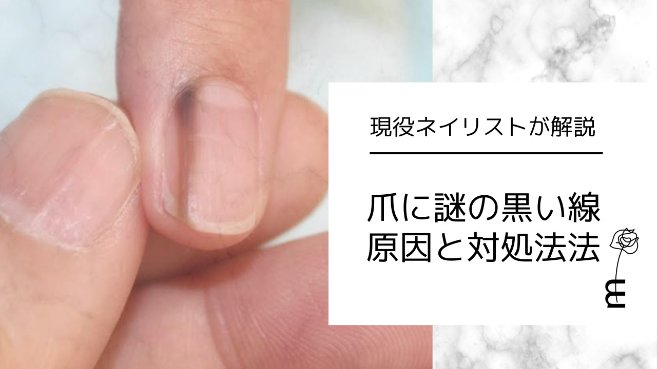 爪の黒い線はがん？メラノーマとほくろの見分け方と危険な初期兆候
