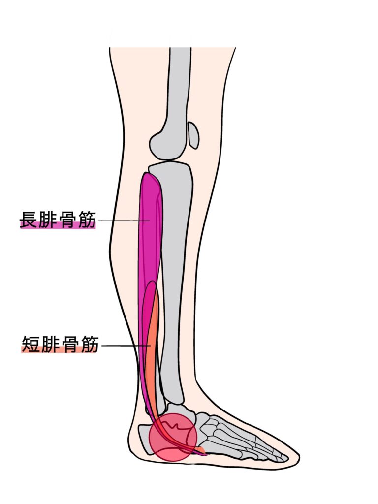 外くるぶしの痛みが治らない？腓骨筋腱炎の重症化を防ぐ治療法