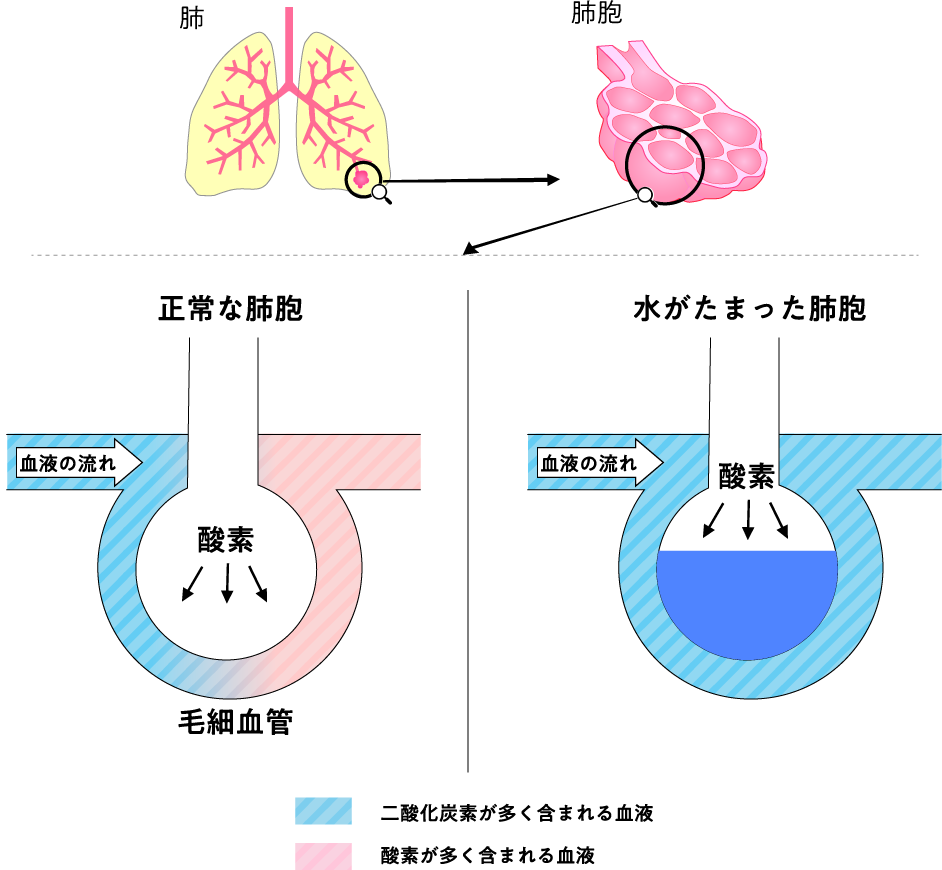 肺水腫とは？突然の呼吸困難や泡状の痰が示す危険と救命の初期症状