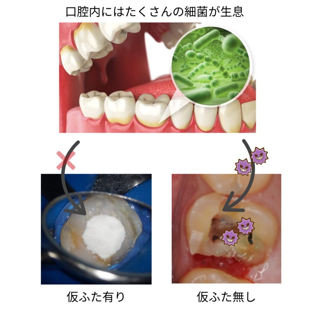 歯の仮詰めが取れた時の応急処置法｜絶対Ng行動と放置リスクを解説