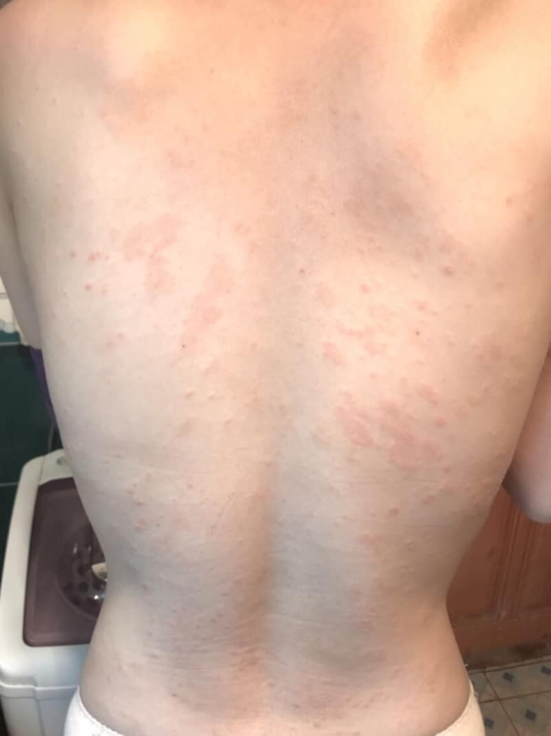 ジベル薔薇色粃糠疹の写真で見るヘラルド斑と初期症状｜うつる？治るまでを徹底解説