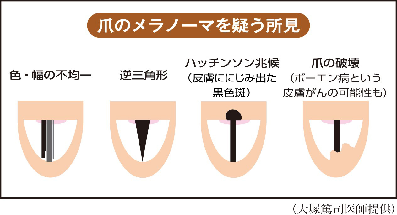 爪の黒い縦線は病気のサイン？メラノーマの見分け方と受診目安