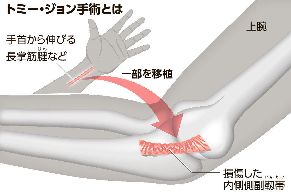 トミージョン手術2回目の復帰率と限界｜大谷翔平の事例から迫る真相