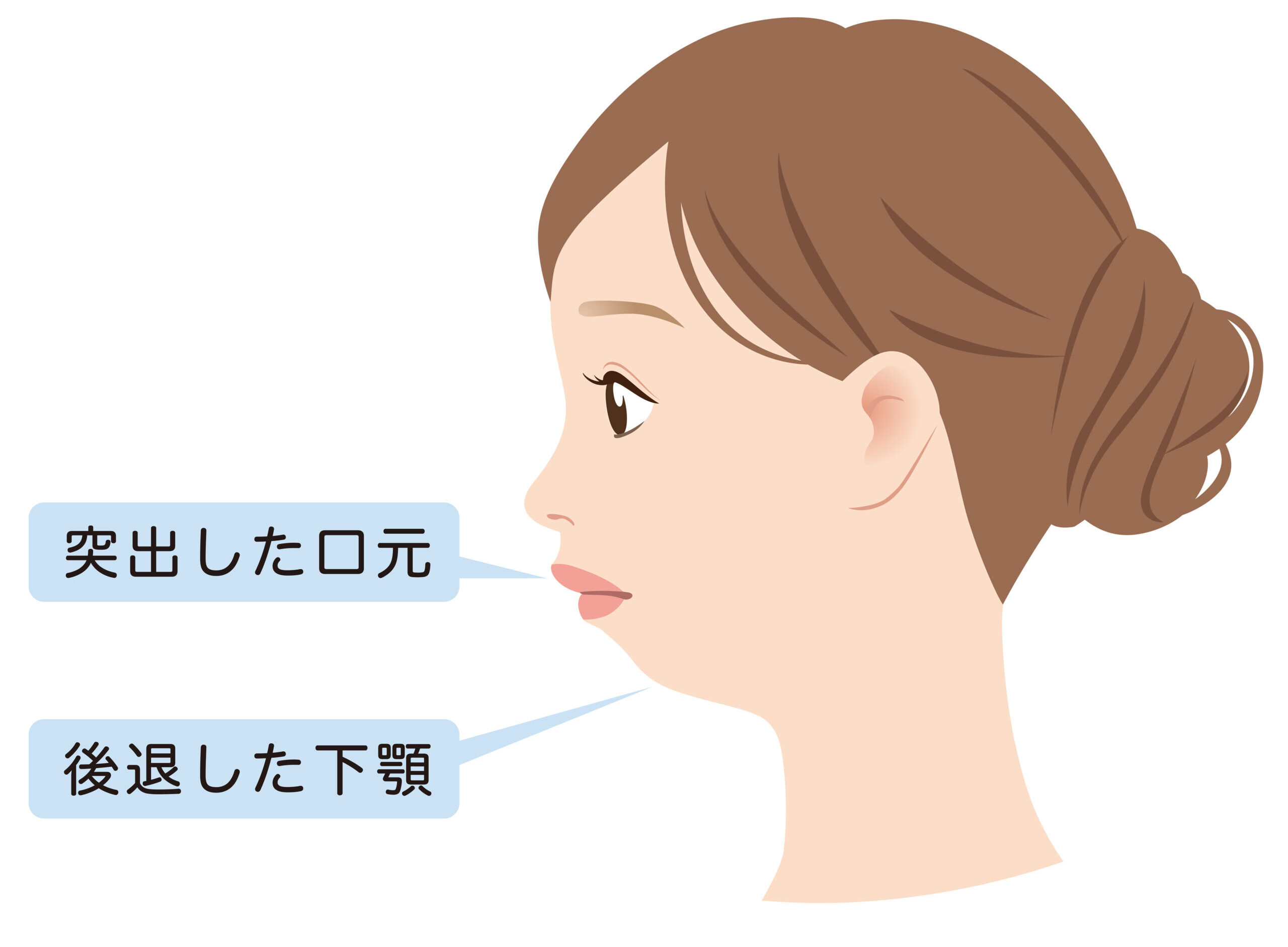 顎がない原因と改善策の全貌｜横顔の悩み・アデノイド顔貌から最新医療まで