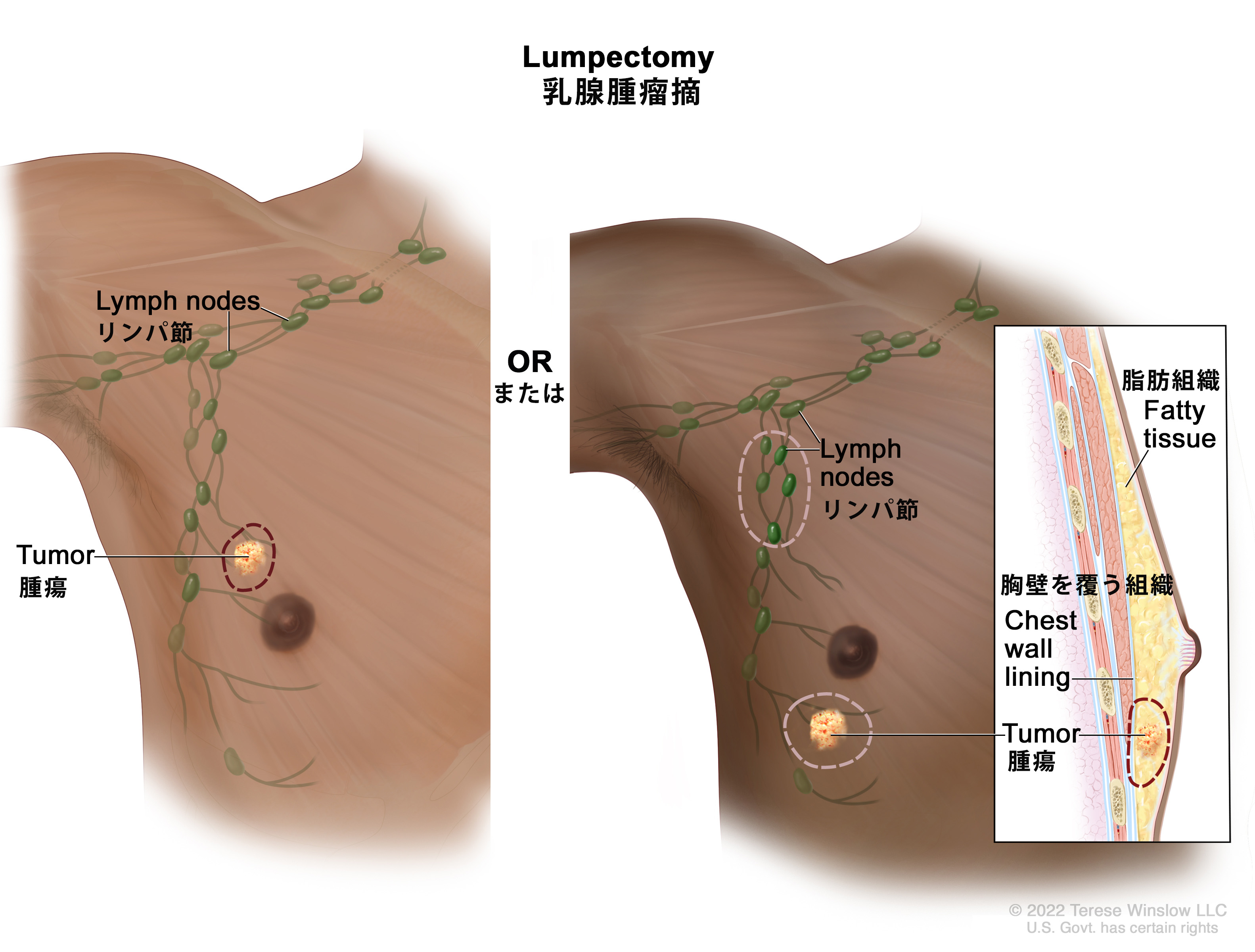 男性乳がんの画像と初期症状｜しこり・分泌物の見分け方と最新治療