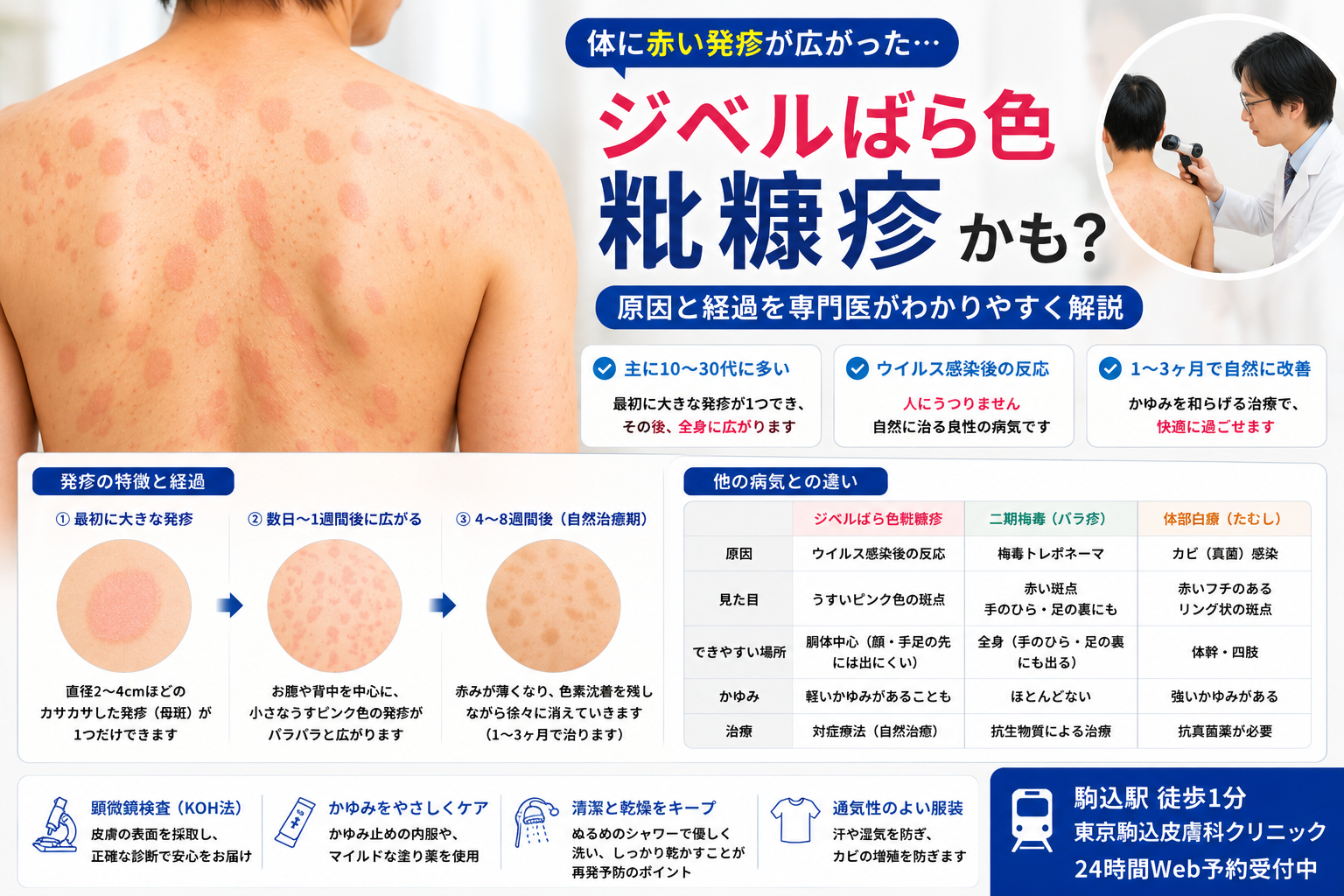 ジベル薔薇色粃糠疹とストレスの真相｜原因と完治期間を徹底解説