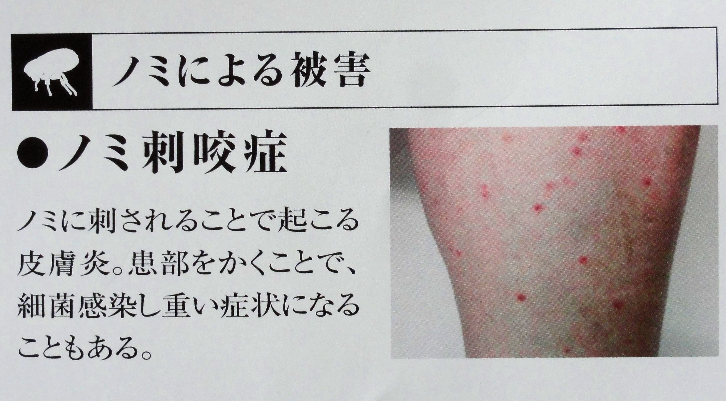 ノミに刺された症状を写真で確認！猛烈なかゆみの正体と跡を残さない治し方