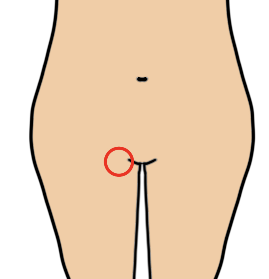 股のしこりは粉瘤？痛い・臭い原因と受診科や手術費用を徹底解説
