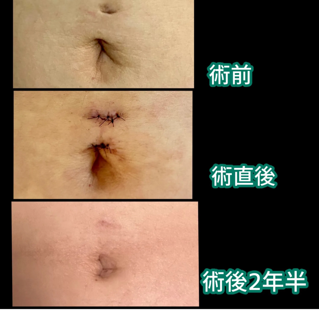 へそピアスの跡を綺麗に消す方法｜しこり・黒ずみ治療と隠し方を徹底解説