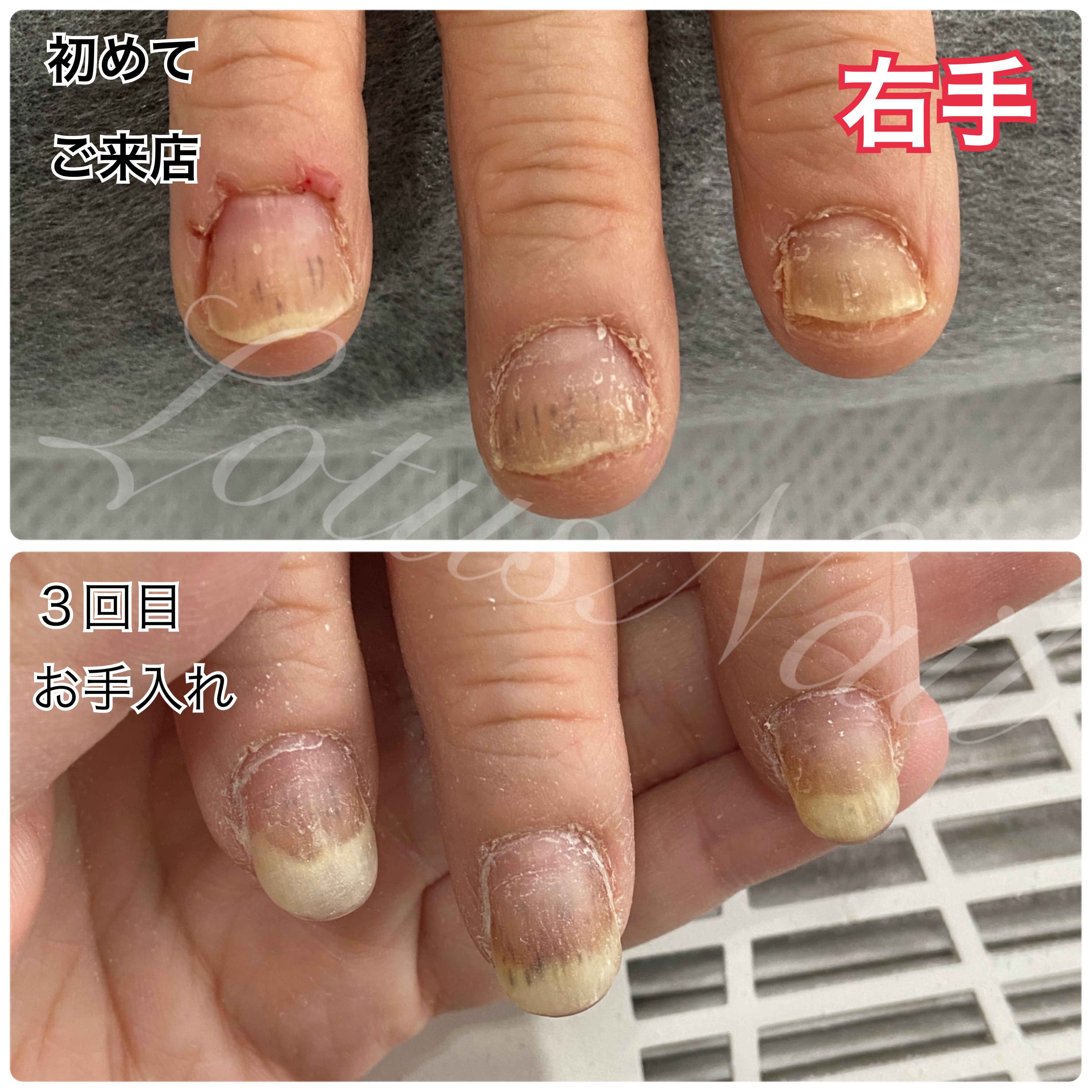 ジェルネイルアレルギーの初期症状と治し方｜原因物質と市販薬・対策を徹底検証