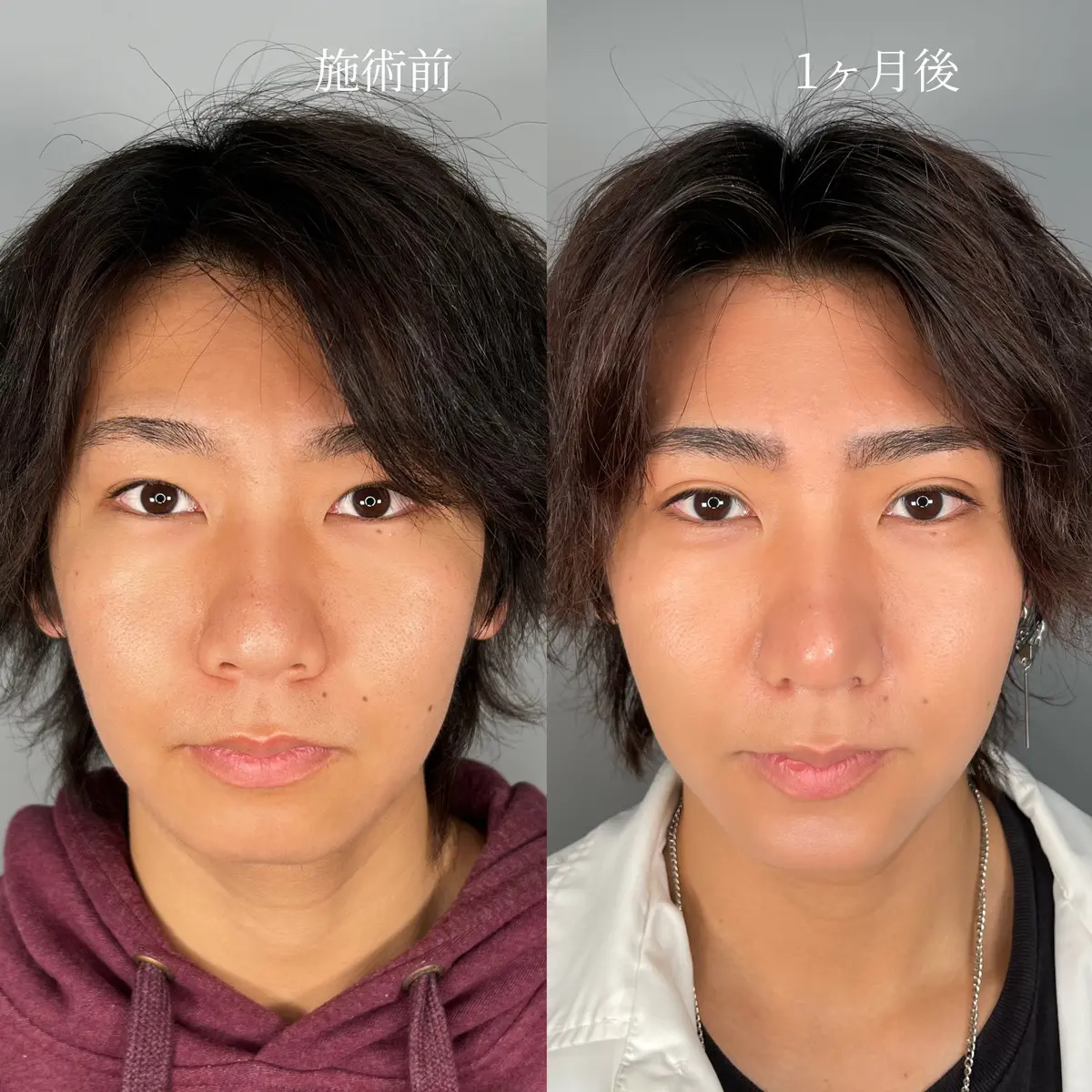 「男の二重は気持ち悪い」の真相｜不自然に見える原因と女性の本音を検証