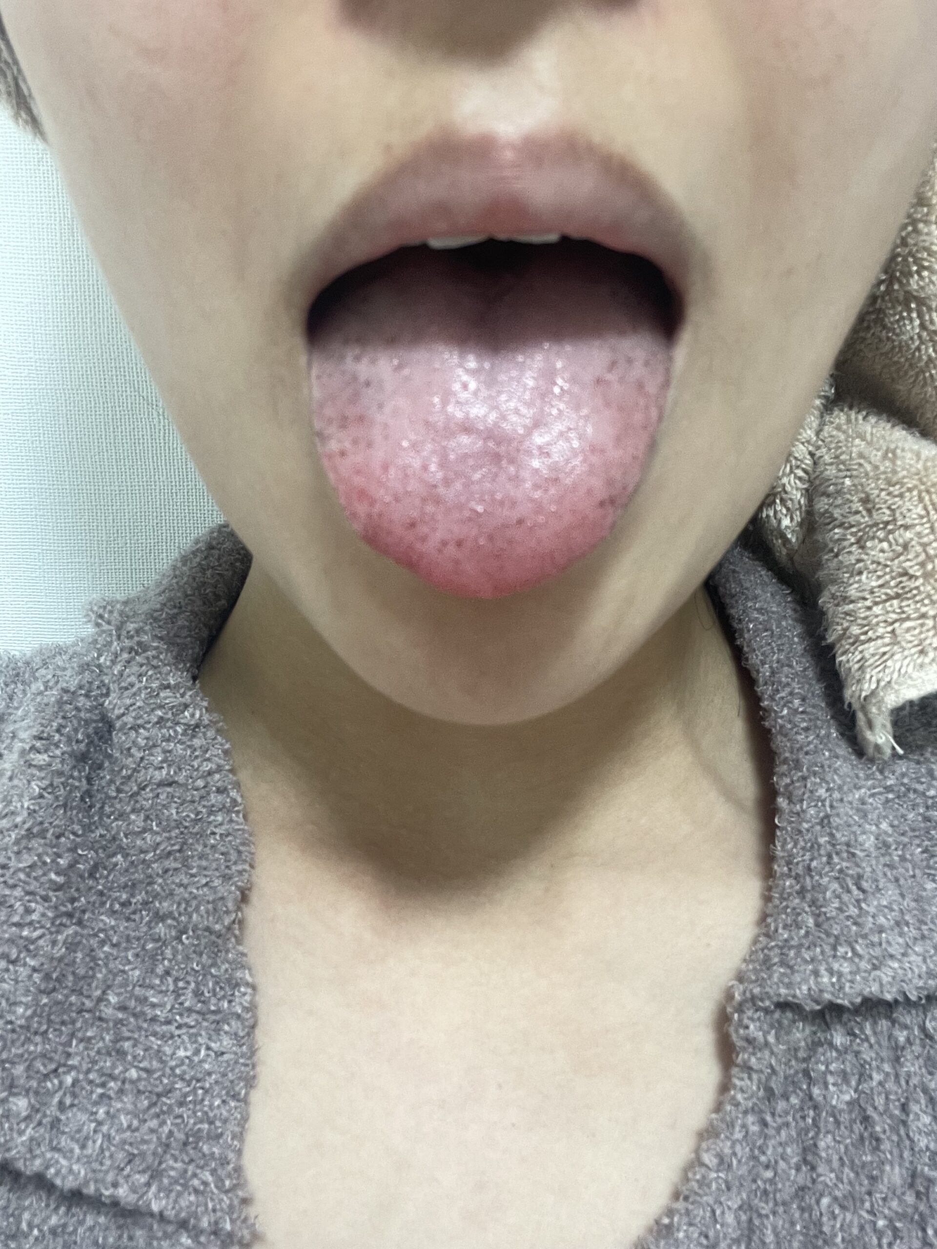 舌に黒い点？血豆とメラノーマの決定的な見分け方と受診目安【2026】