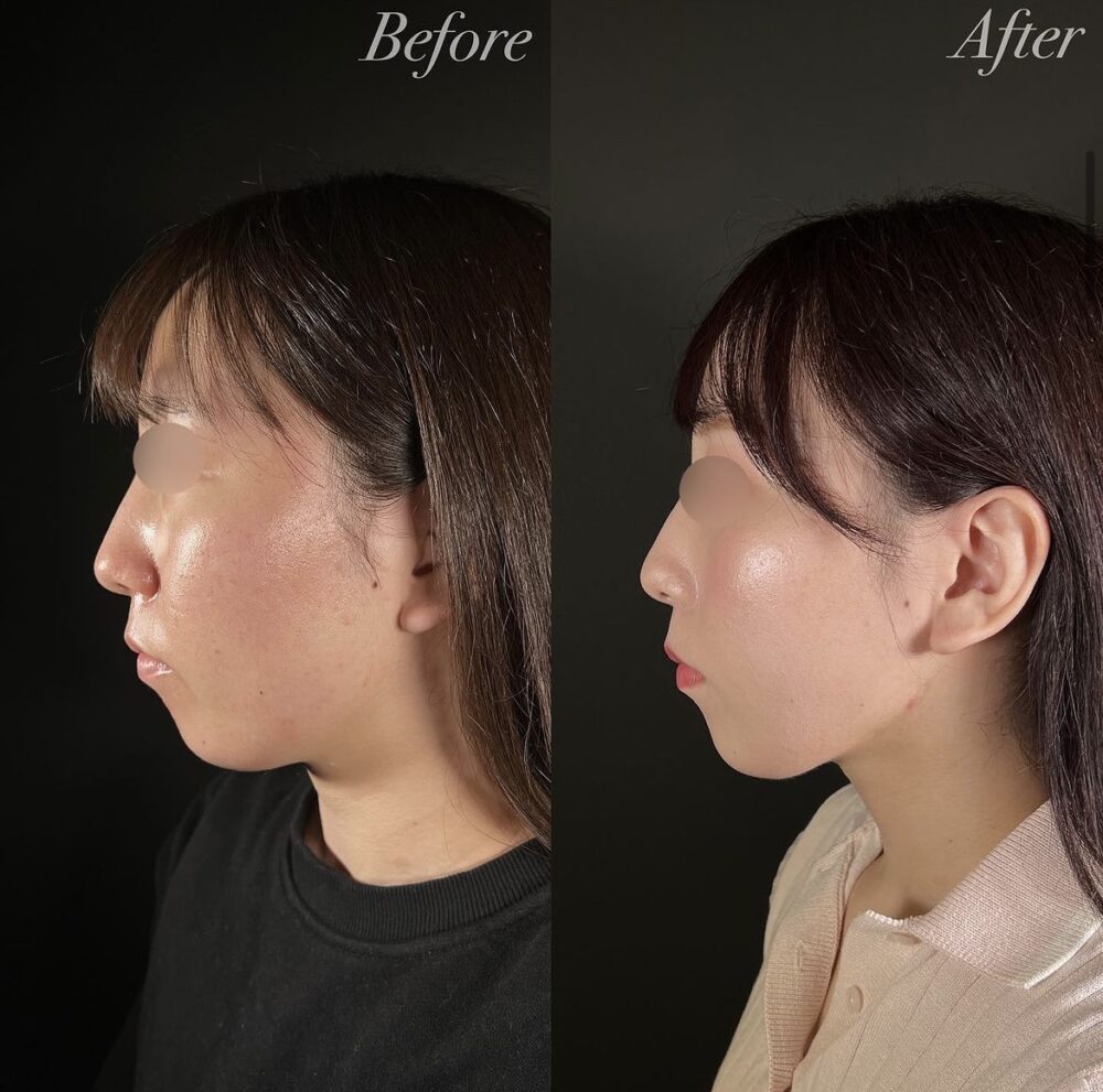 痩せても顎下の肉が消えない理由とは？即効で二重あごを解消する最新策
